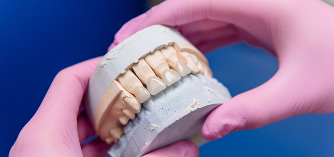 Протезирование зубов в Смоленке, вкладки, виниры в стоматологии Оптима