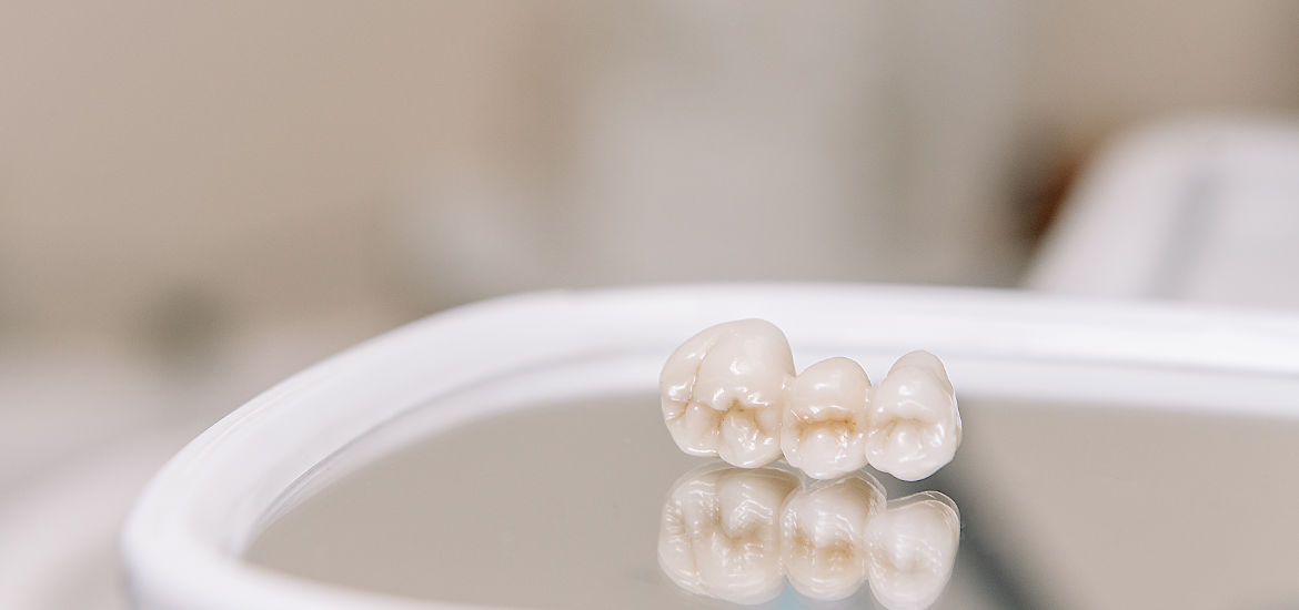 Протезирование зубов в Смоленке, вкладки, виниры в стоматологии Оптима